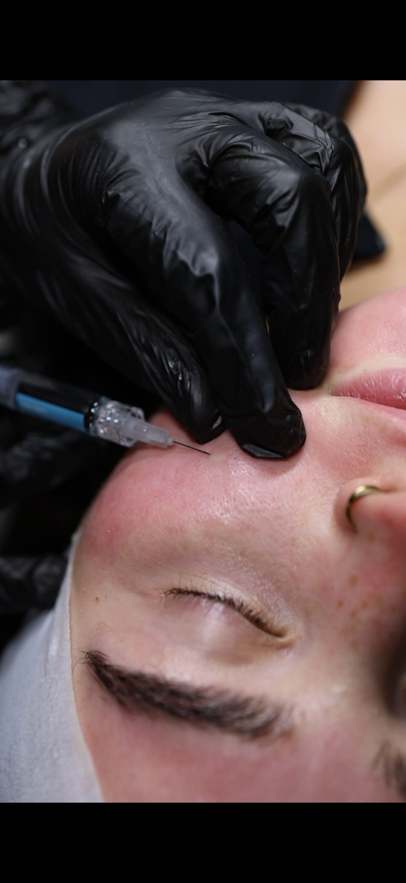 Skin Boosters
